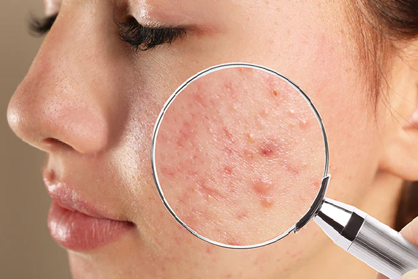 Acne Pimples