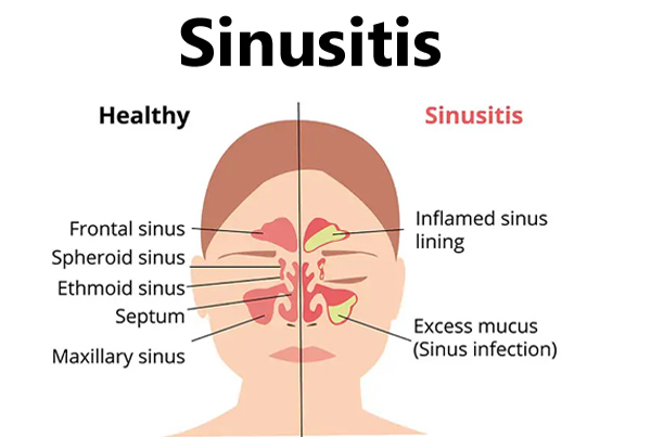 Sinus