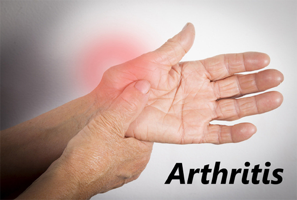 Arthritis