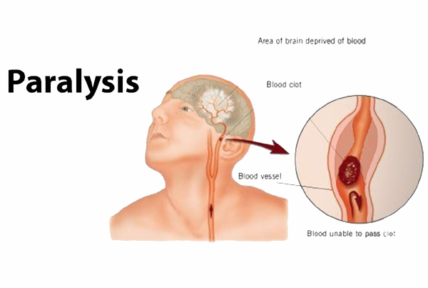 Paralysis