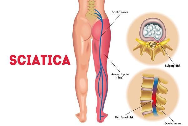 Sciatica